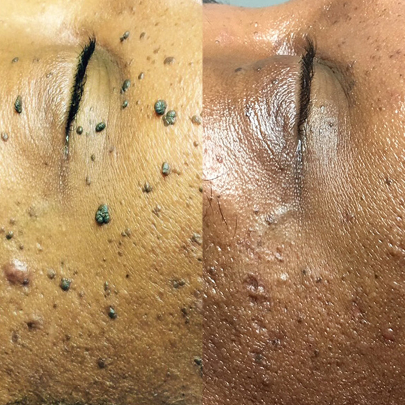Dermatosis Papulosa Nigra (DPN) removal in Croydon | JH Skincare Clinic Sydenham