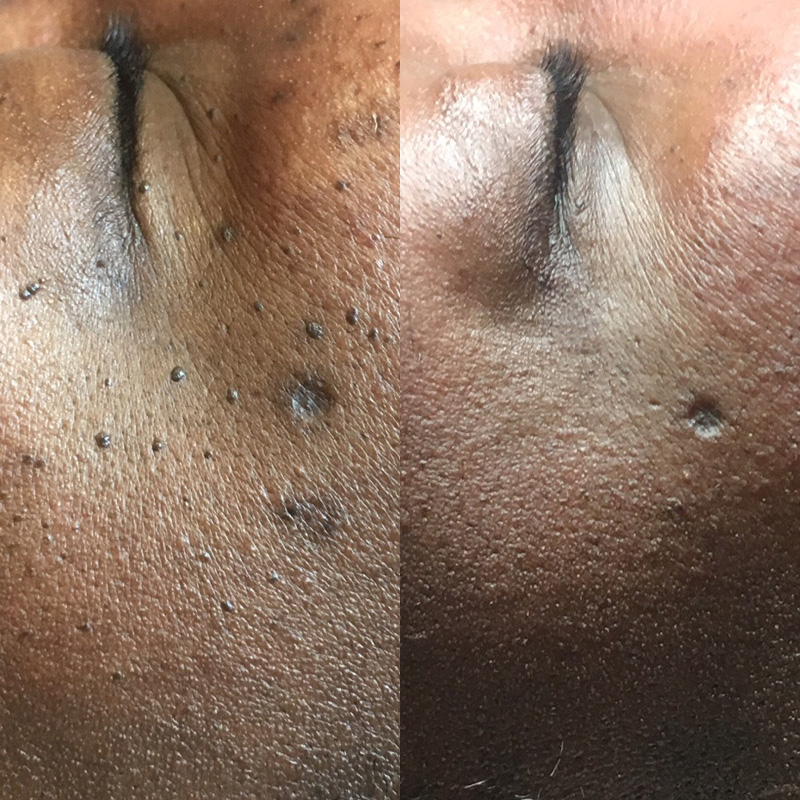 Dermatosis Papulosa Nigra (DPN) removal in Croydon | JH Skincare Clinic Sydenham