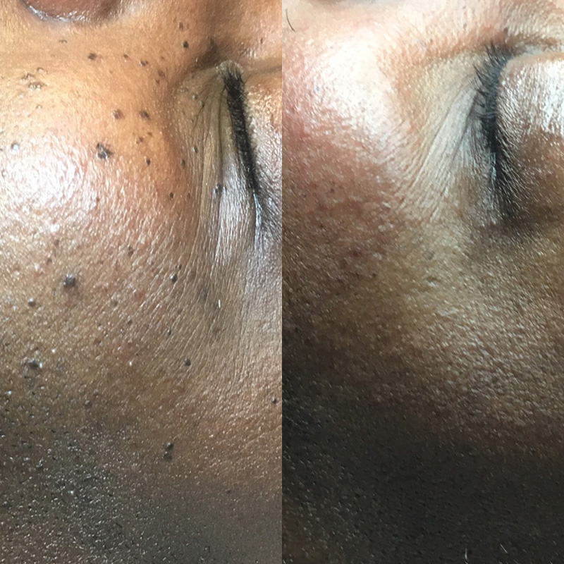 Dermatosis Papulosa Nigra (DPN) removal in Croydon | JH Skincare Clinic Sydenham