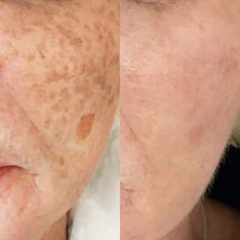 Pigmentation removal on face and hands in Beckenham | JH Skincare Clinic