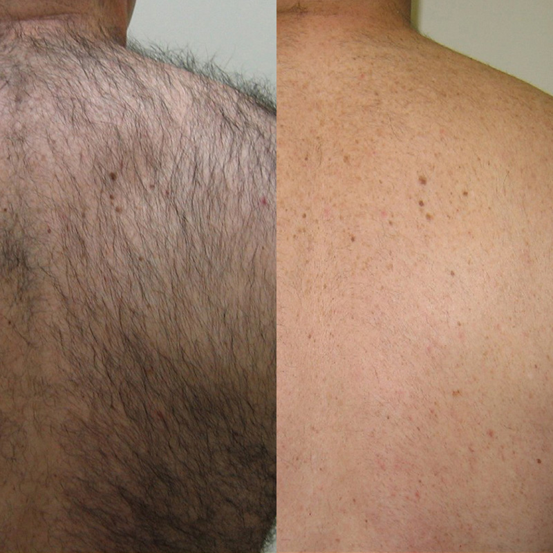 IPL laser facials and hair removal in Beckenham | JH Skincare Clinic