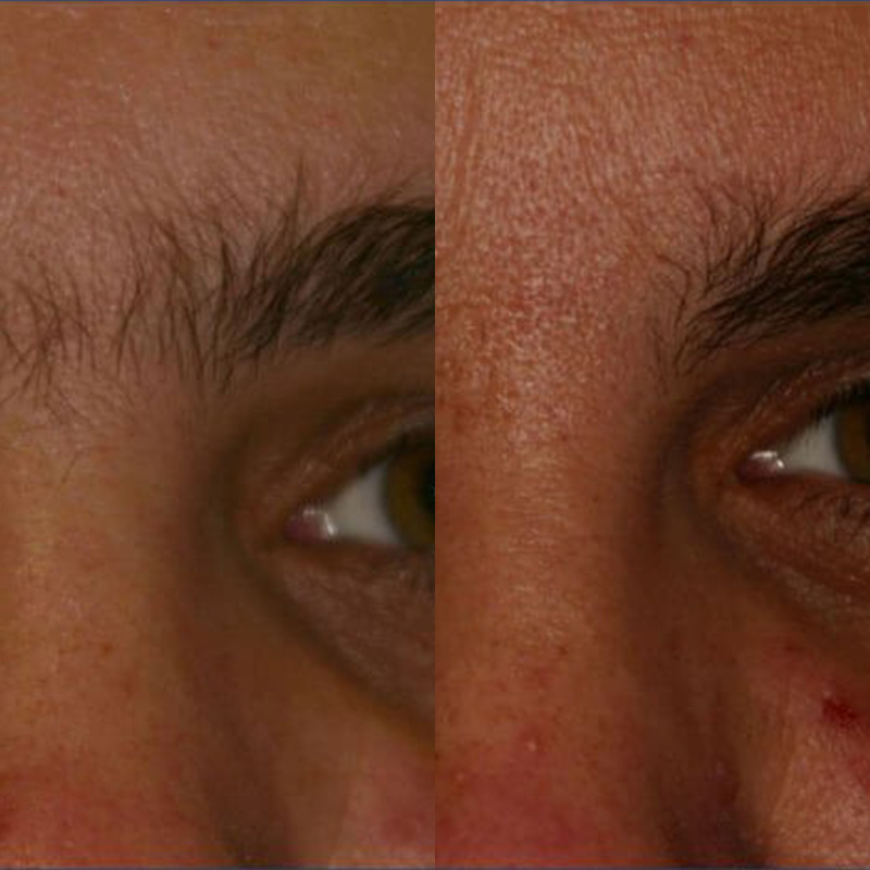 IPL laser facials and hair removal in Beckenham | JH Skincare Clinic