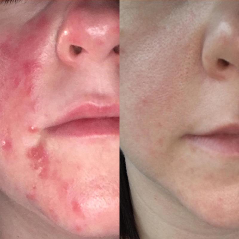 IPL laser facials and hair removal in Beckenham | JH Skincare Clinic